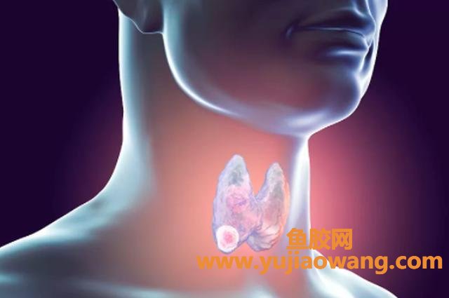 甲状腺结节能吃桃胶吗(甲状腺结节能吃桃胶吗)