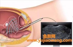 花胶对子宫内膜息肉有影响吗(吃花胶会长子宫内膜息肉吗)