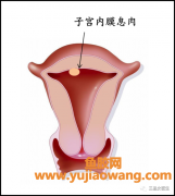 子宫内膜息肉可以吃鱼胶吗(子宫内膜息肉可以吃鱼胶吗)