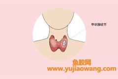 吃鱼胶导致甲状腺结节(甲状腺结节手术后可以吃鱼胶吗)