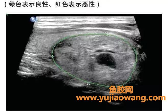 蜂胶与甲状腺结节(甲状腺结节可以吃黑蜂胶吗)