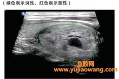 蜂胶与甲状腺结节(甲状腺结节可以吃黑蜂胶吗)