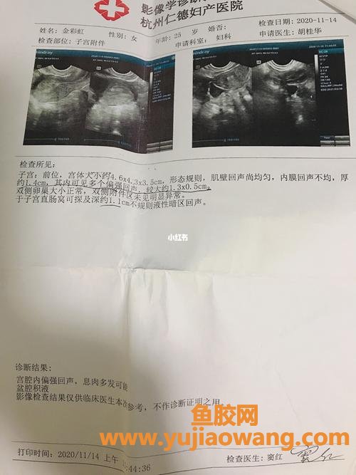 花胶对子宫内膜息肉有影响吗(子宫内膜息肉 花胶)