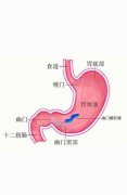 糜烂性胃炎可以吃鱼胶吗(糜烂性胃炎吃哪些药)