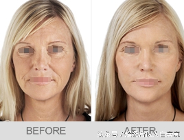 (鱼胶原蛋 乳腺增生)如何吃出满满的胶原蛋白_ (鱼胶原蛋 乳腺增生)如何吃出满满的胶原蛋白_