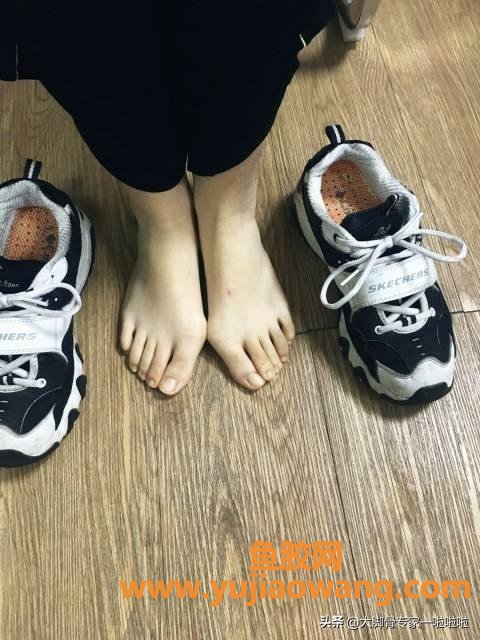 拇外翻怎么治疗好 拇外翻怎么治疗好