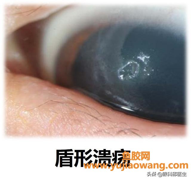 慢性过敏性结膜炎 慢性过敏性结膜炎多久自愈 慢性过敏性结膜炎 慢性过敏性结膜炎多久自愈