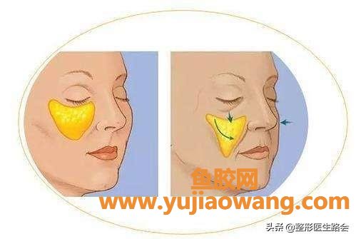 泪沟是什么 泪沟是什么样的图片 泪沟是什么 泪沟是什么样的图片