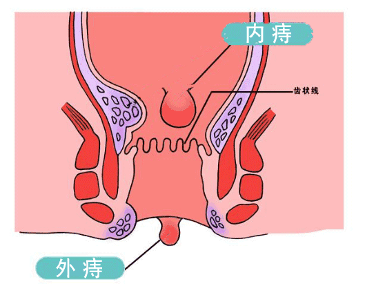 如何自己治疗痔疮 痔疮如何自我治疗方法 如何自己治疗痔疮 痔疮如何自我治疗方法